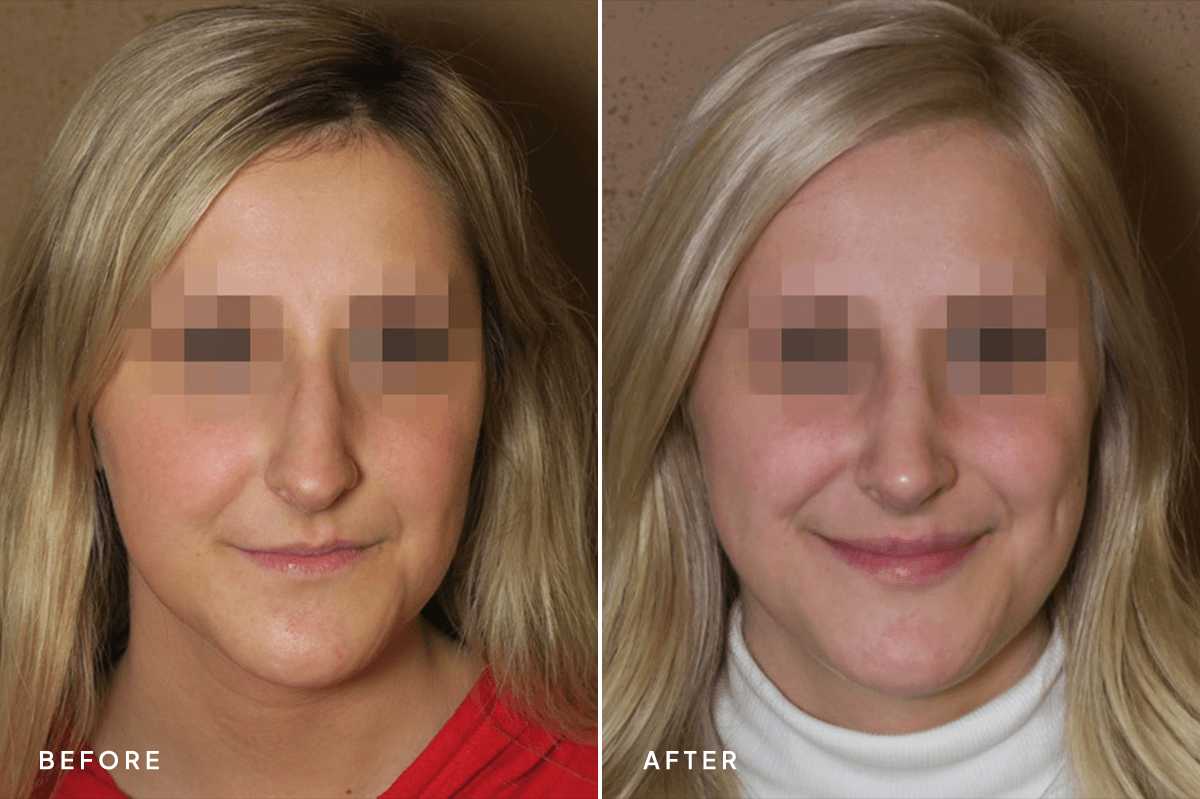 New Horizons Face Gallery | Rhinoplasty | 414-rhinoplasty | A Front