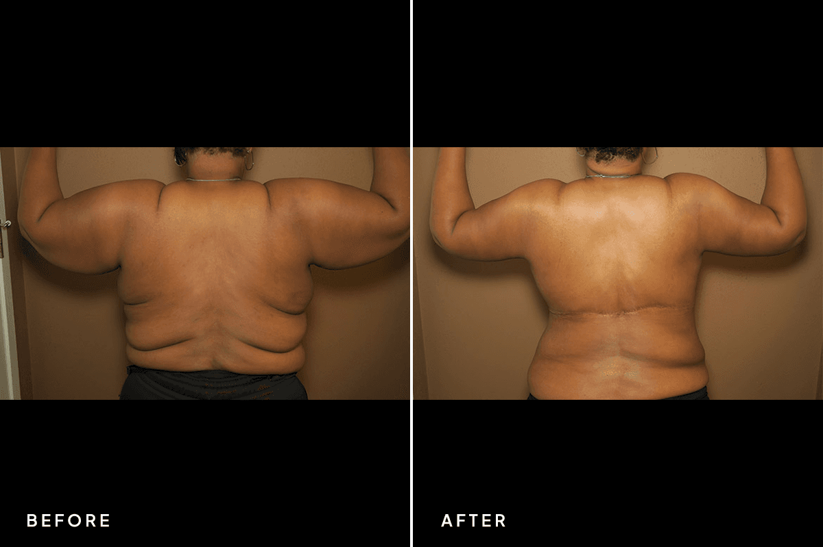New Horizons Body Gallery | Weight Loss | 58-belt-lipectomy | A Back