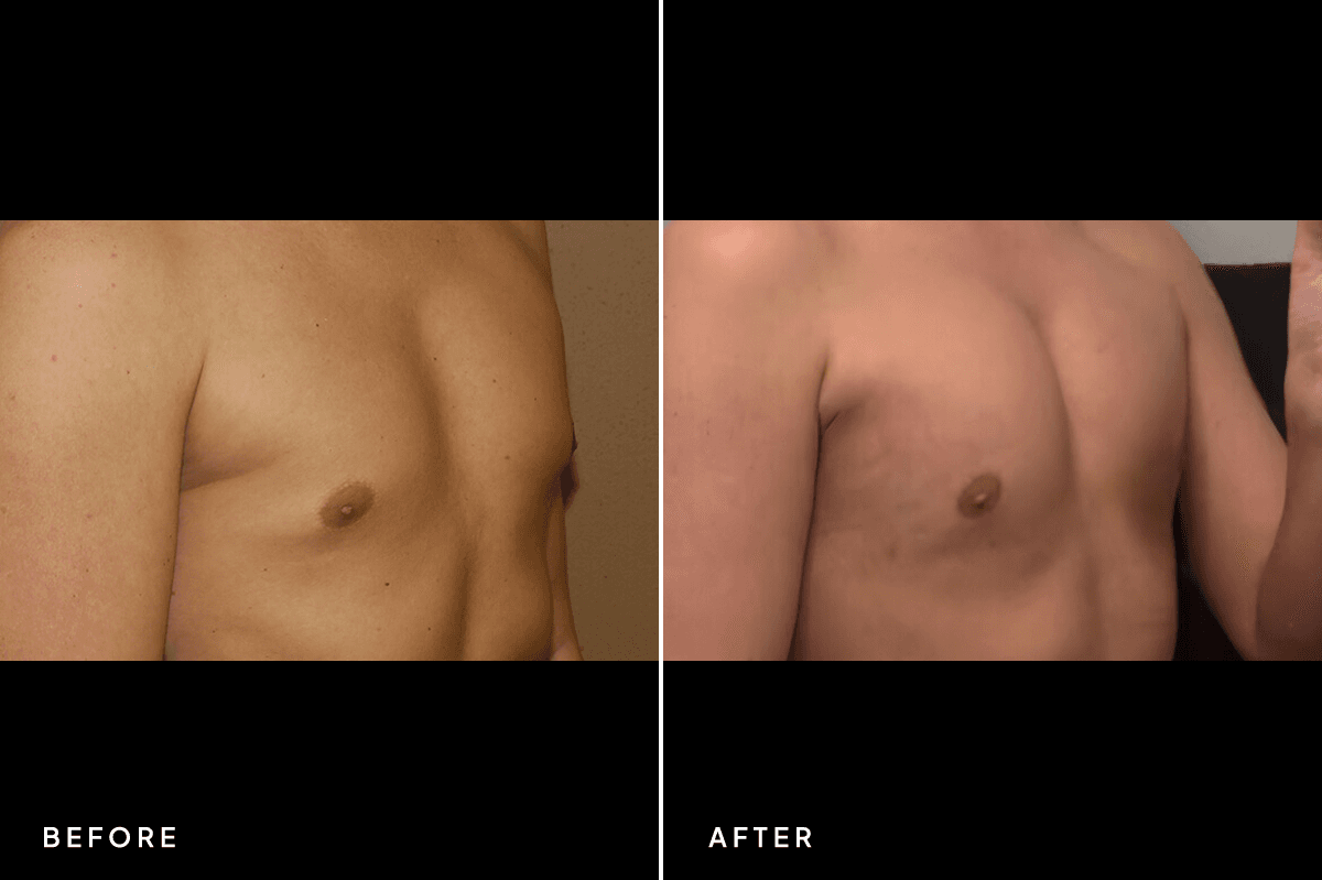 New Horizons Breast Gallery | Pec Implants | 7060-pec-implants | B Angle