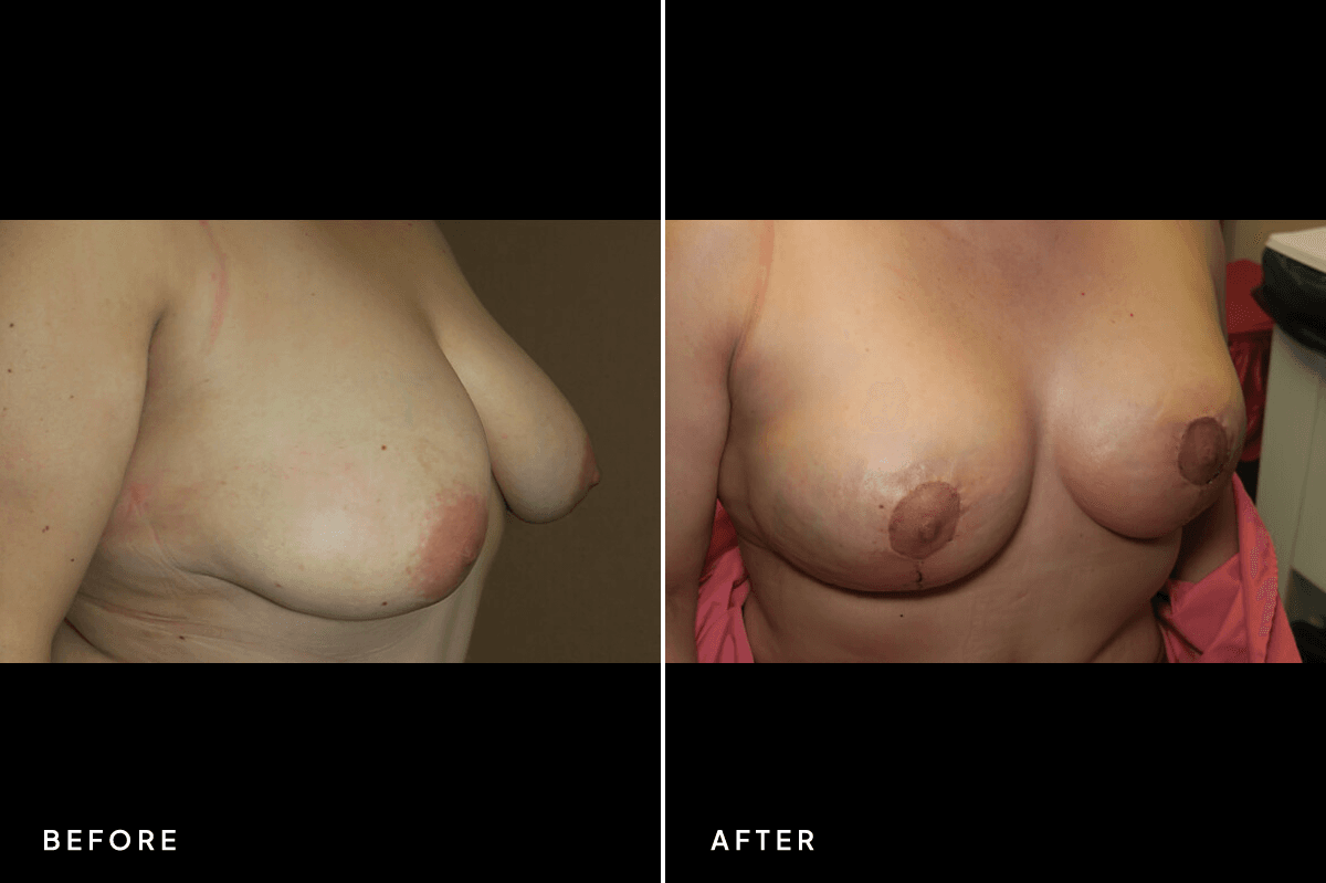 New Horizons Breast Gallery | Breast Lift With Implants | 6773-breast-lift | B Side