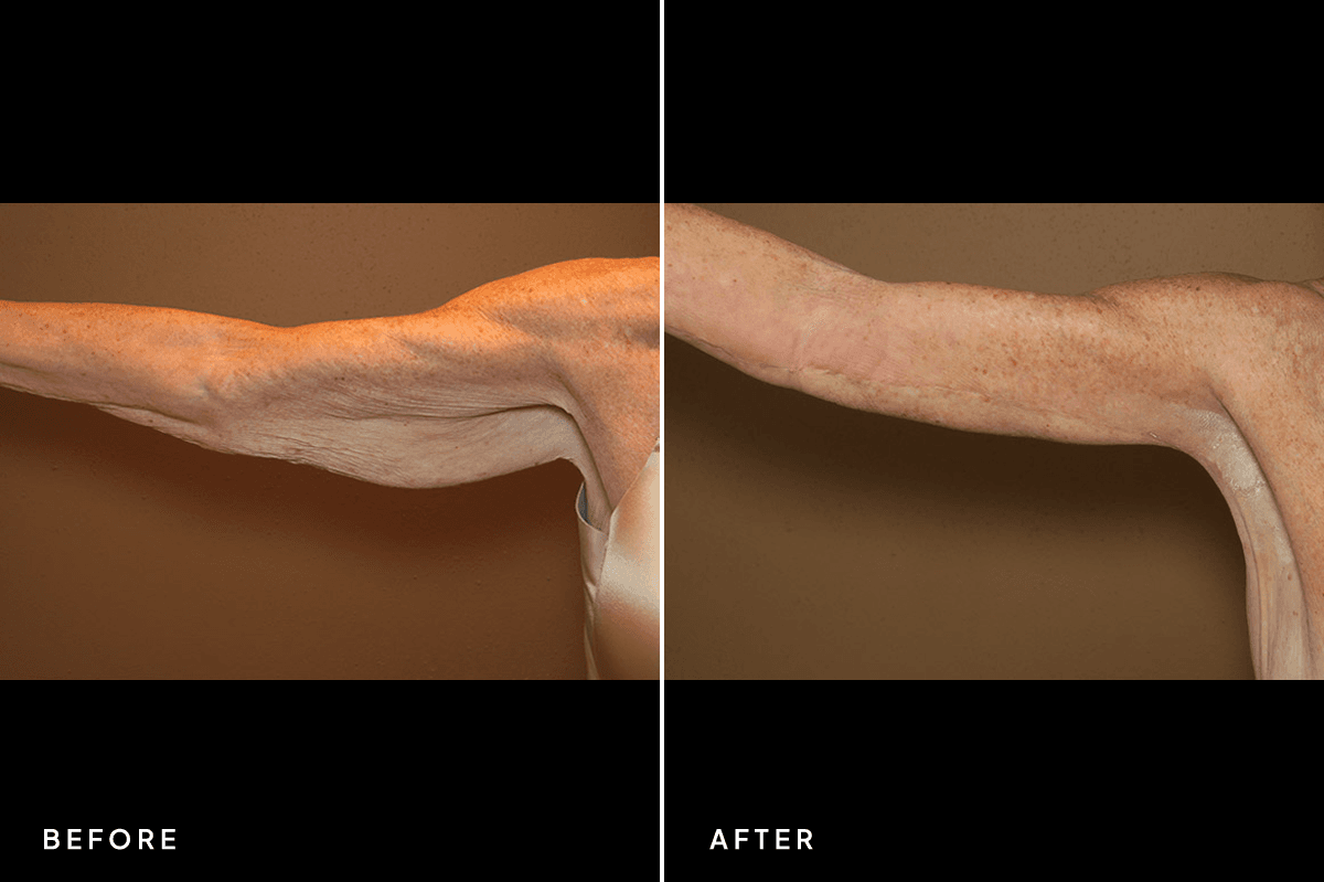 New Horizons Body Gallery | Weight Loss | 32-armlift | B Right