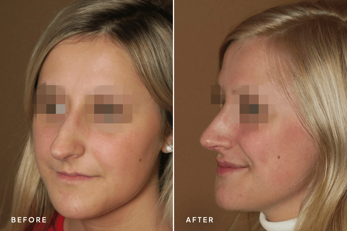 New Horizons Face Gallery | Rhinoplasty | 414-rhinoplasty | C Angle