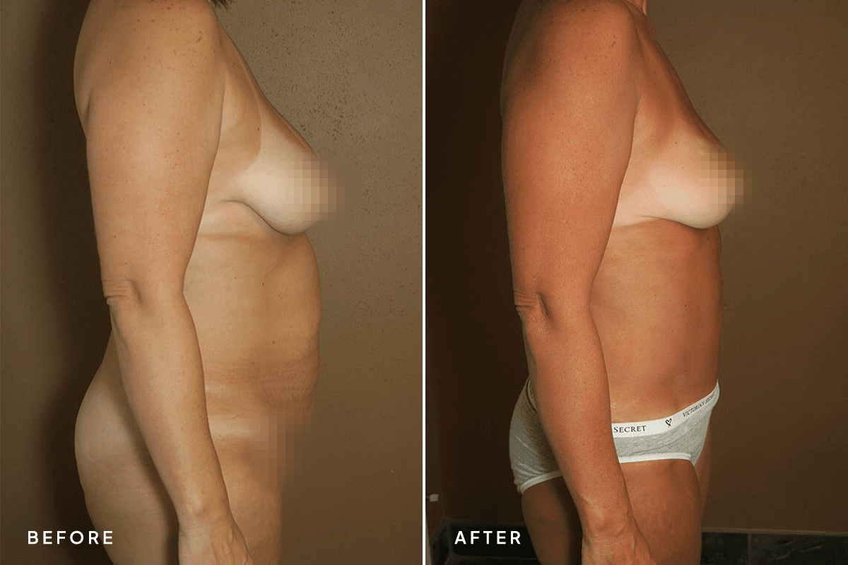 New Horizons Body Gallery | Mommy Makeover | 61-mommy-makeover | B Side