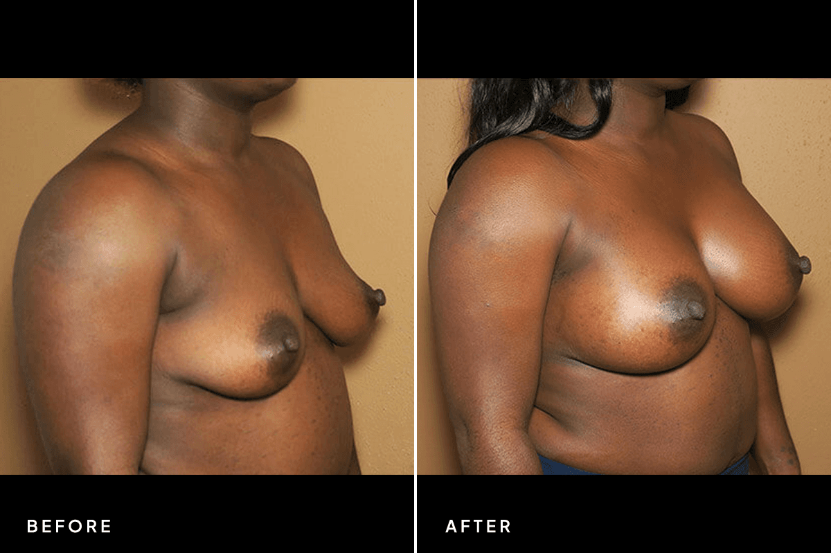 New Horizons Breast Gallery | Breast augmentation - All Endoscopic | 320-breast-augmentation | B Side