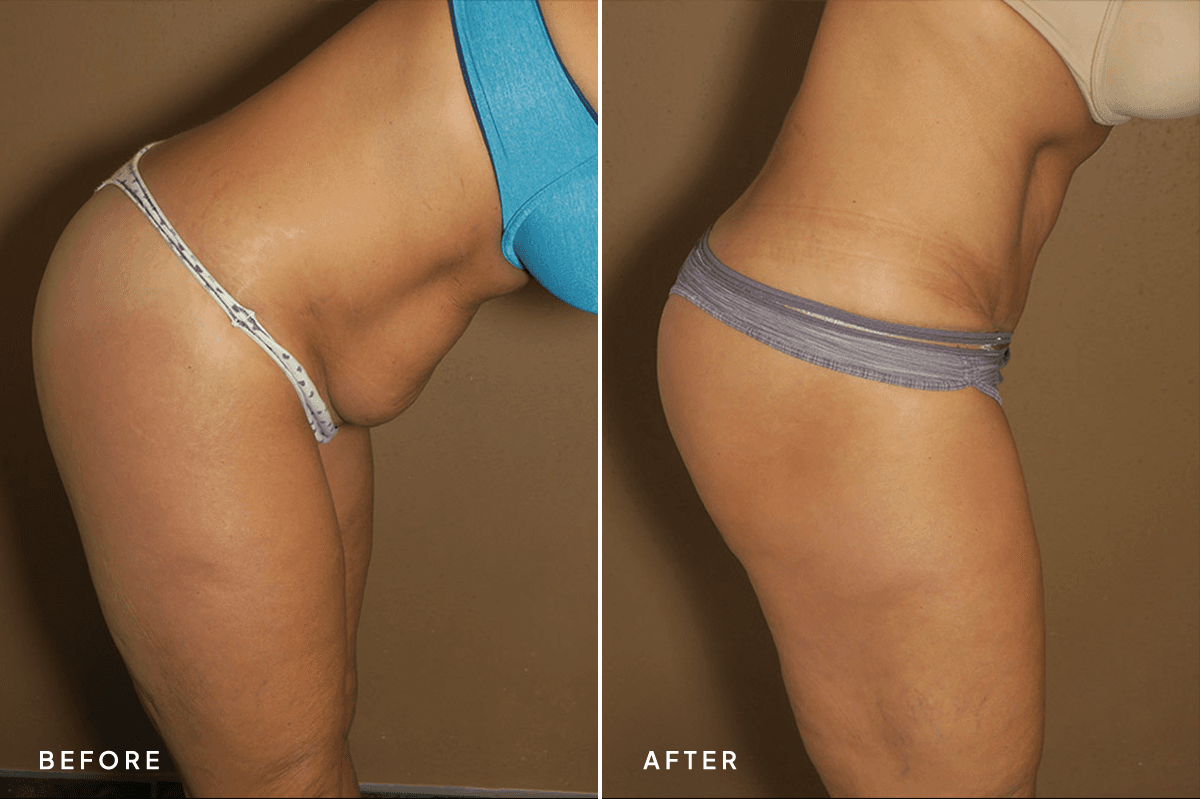 New Horizons Body Gallery | Tummy Tuck | 55-abdominoplasty | C Side