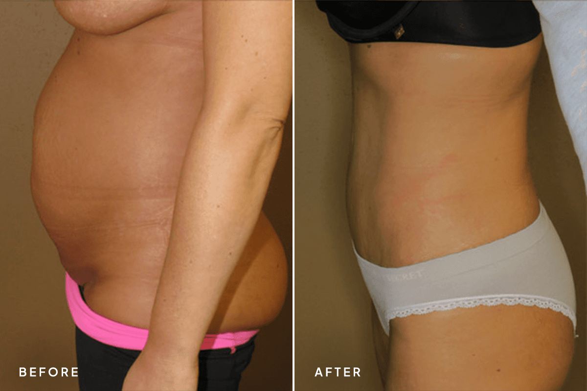 New Horizons Body Gallery | Tummy Tuck | 064-tummy-tuck | B Side