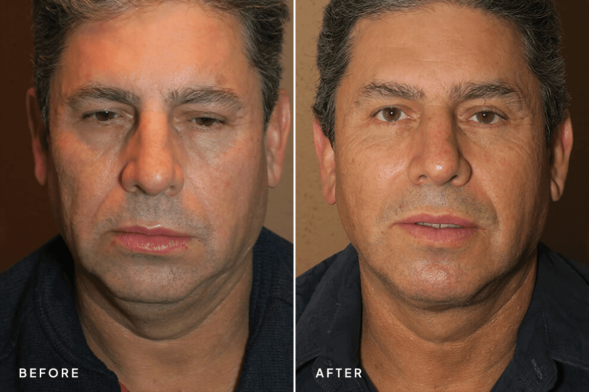 New Horizons Face Gallery | Male Face Neck Lift | 6867-neck-lift | A Front