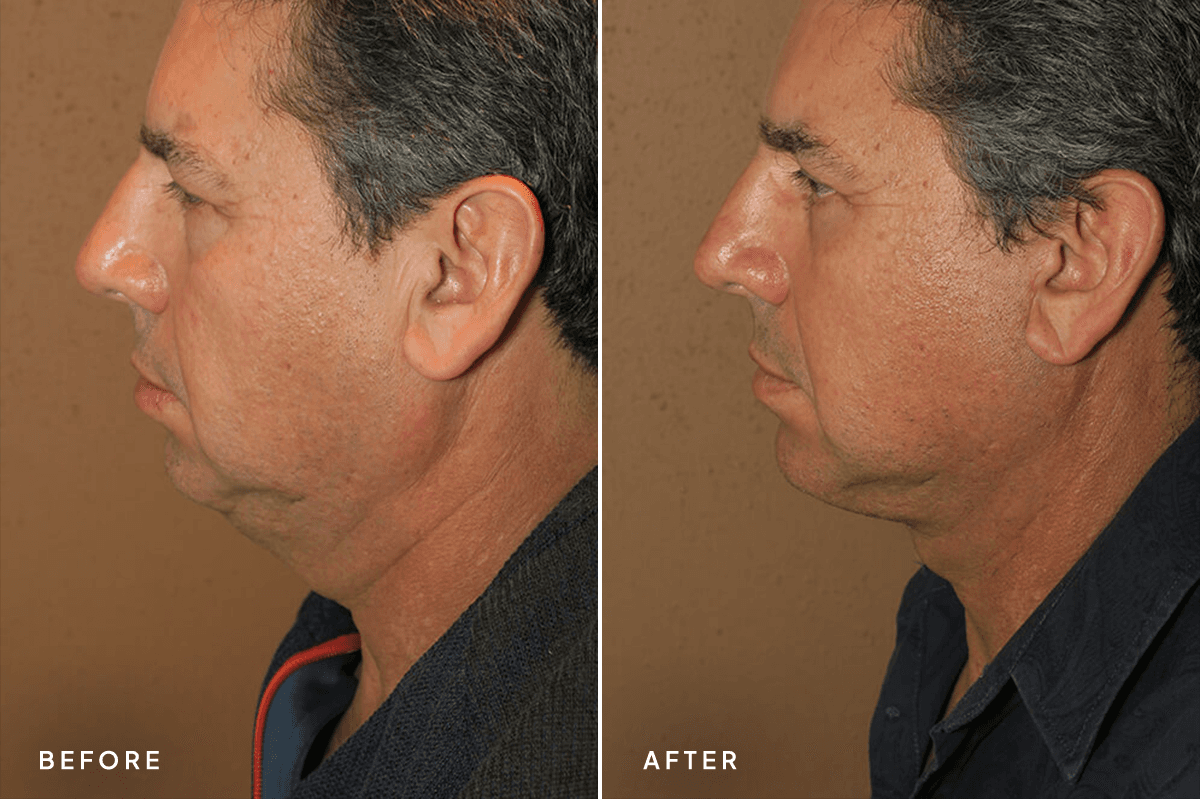 New Horizons Face Gallery | Male Face Neck Lift | 6867-neck-lift | B Side