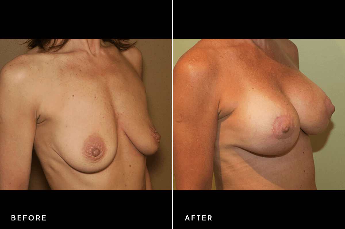 New Horizons Breast Gallery | Breast Lift With Implants | 7084-breast-lift | C Angle