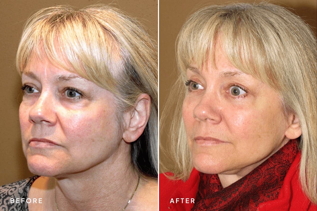 New Horizons Face Gallery | Rhinoplasty | Mid Face Lift | B Side