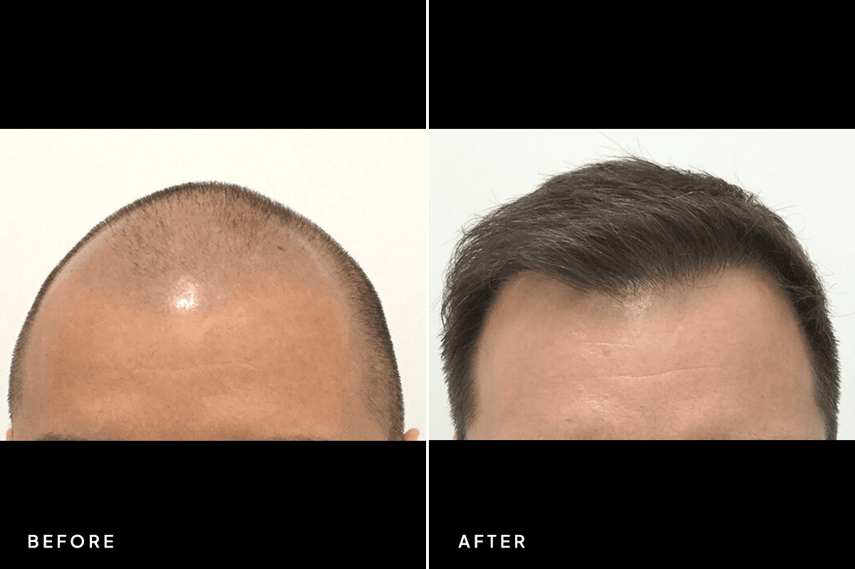 New Horizons Hair Gallery | Hair Transplant | 6625-artas-hair-restoration | A Front