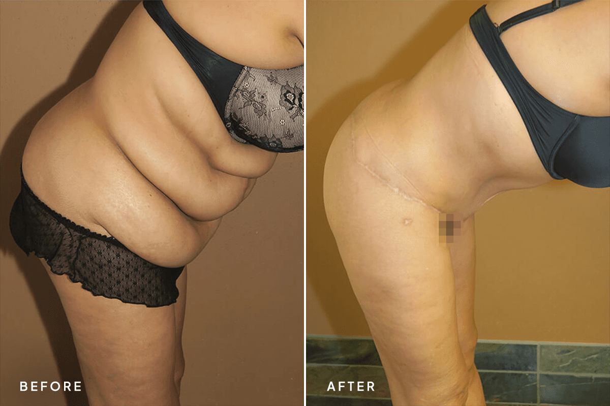 New Horizons Body Gallery | Weight Loss | 7081-belt-lipectomy | C Angle