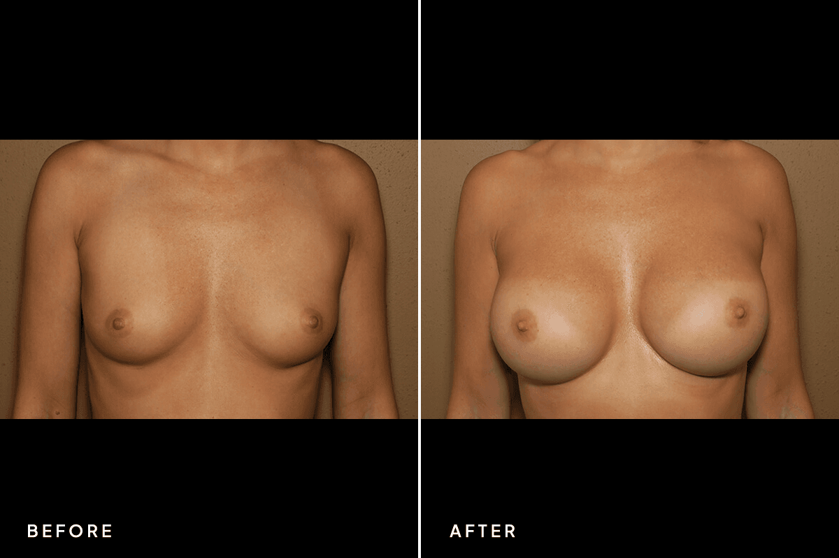 New Horizons Breast Gallery | Breast augmentation - All Endoscopic | 6719-breast-augmentation | A Front