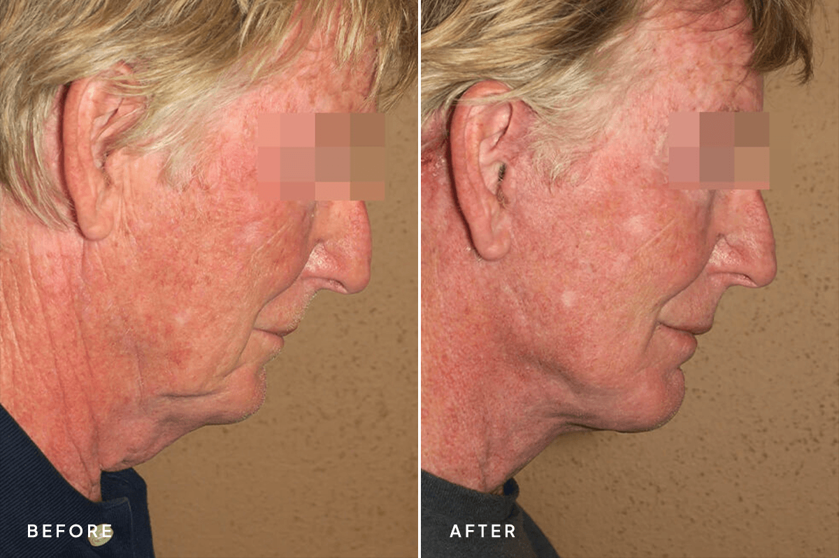 New Horizons Face Gallery | Male Face Neck Lift | 6633-neck-lift | C Angle
