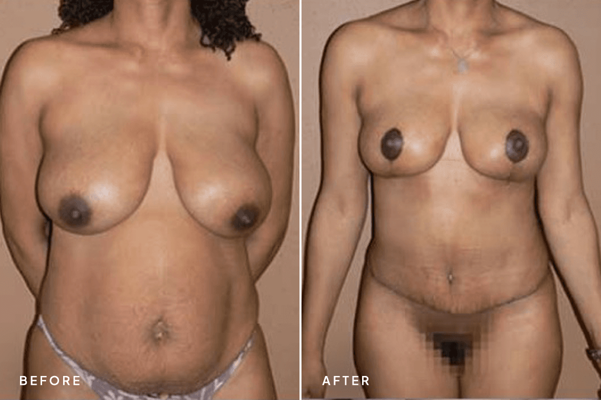 New Horizons Body Gallery | Tummy Tuck | 14-tummy-tuck-abdominoplasty | A Front