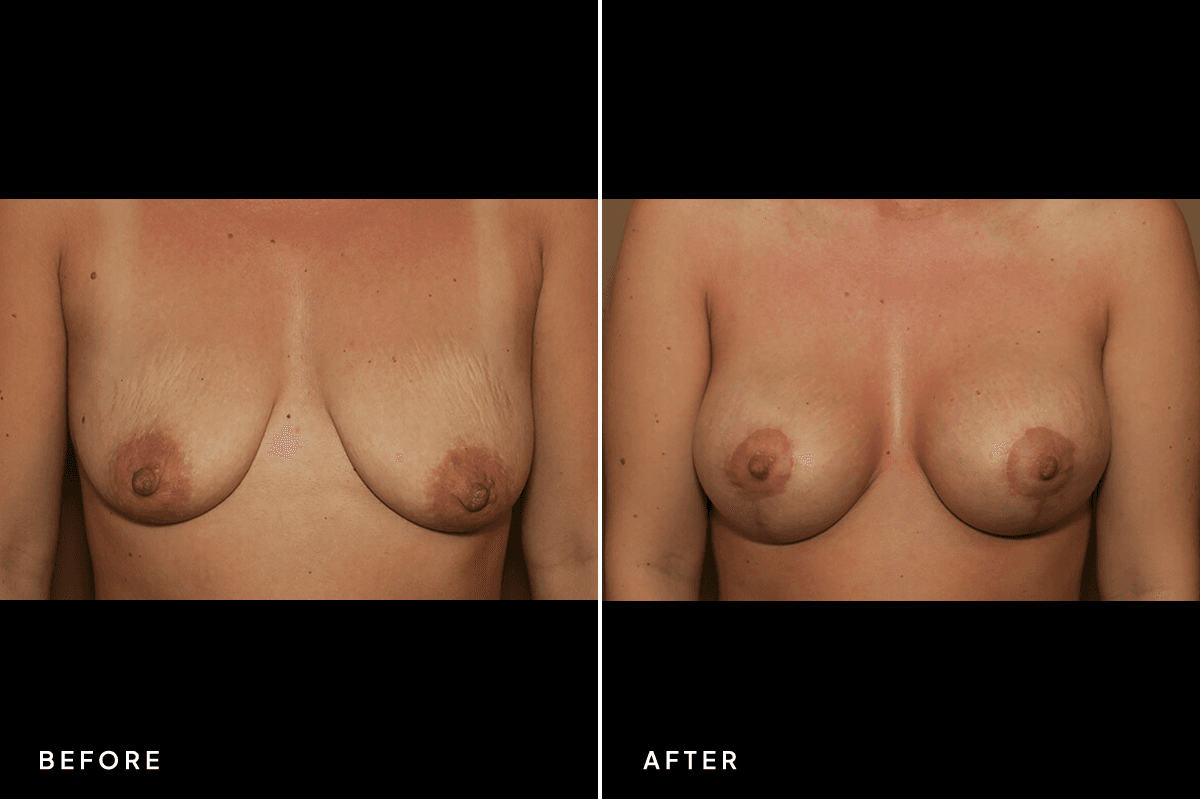 New Horizons Breast Gallery | Breast Lift With Implants | 6801-mastopexy | A Front