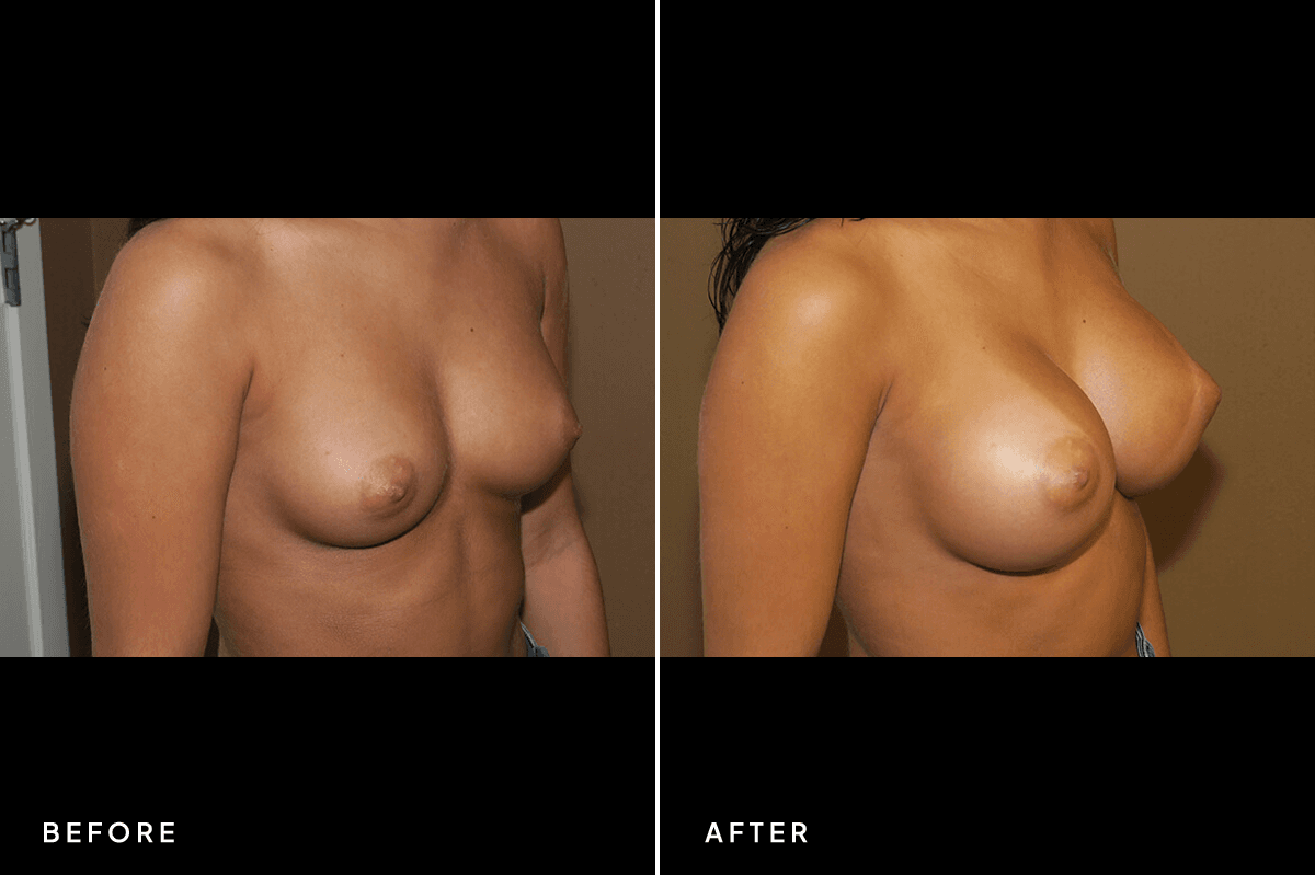 New Horizons Breast Gallery | Breast augmentation - All Endoscopic | 7051-breast-augmentation | B Side