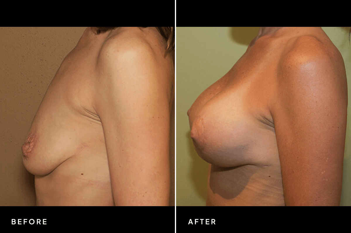 New Horizons Breast Gallery | Breast Lift With Implants | 7084-breast-lift | B Side