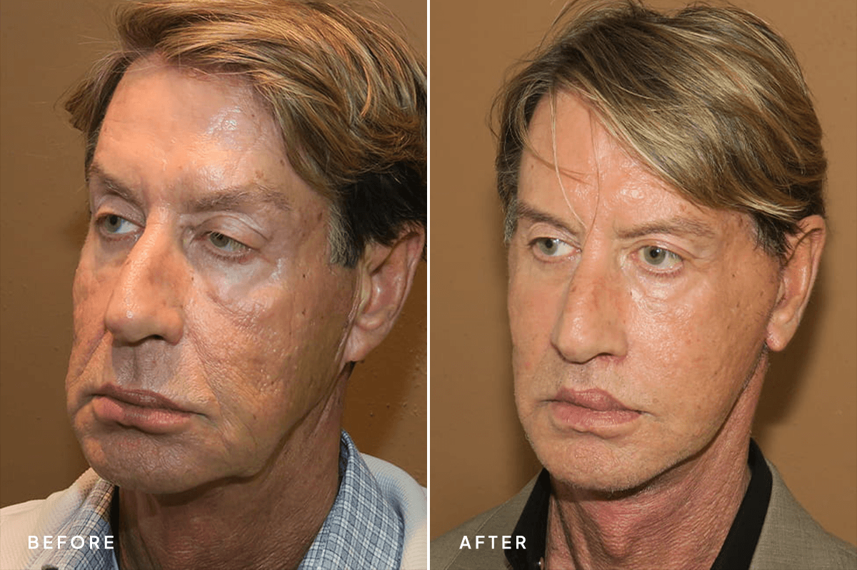 New Horizons Face Gallery | Male Face Neck Lift | 7192-facelift | C Angle