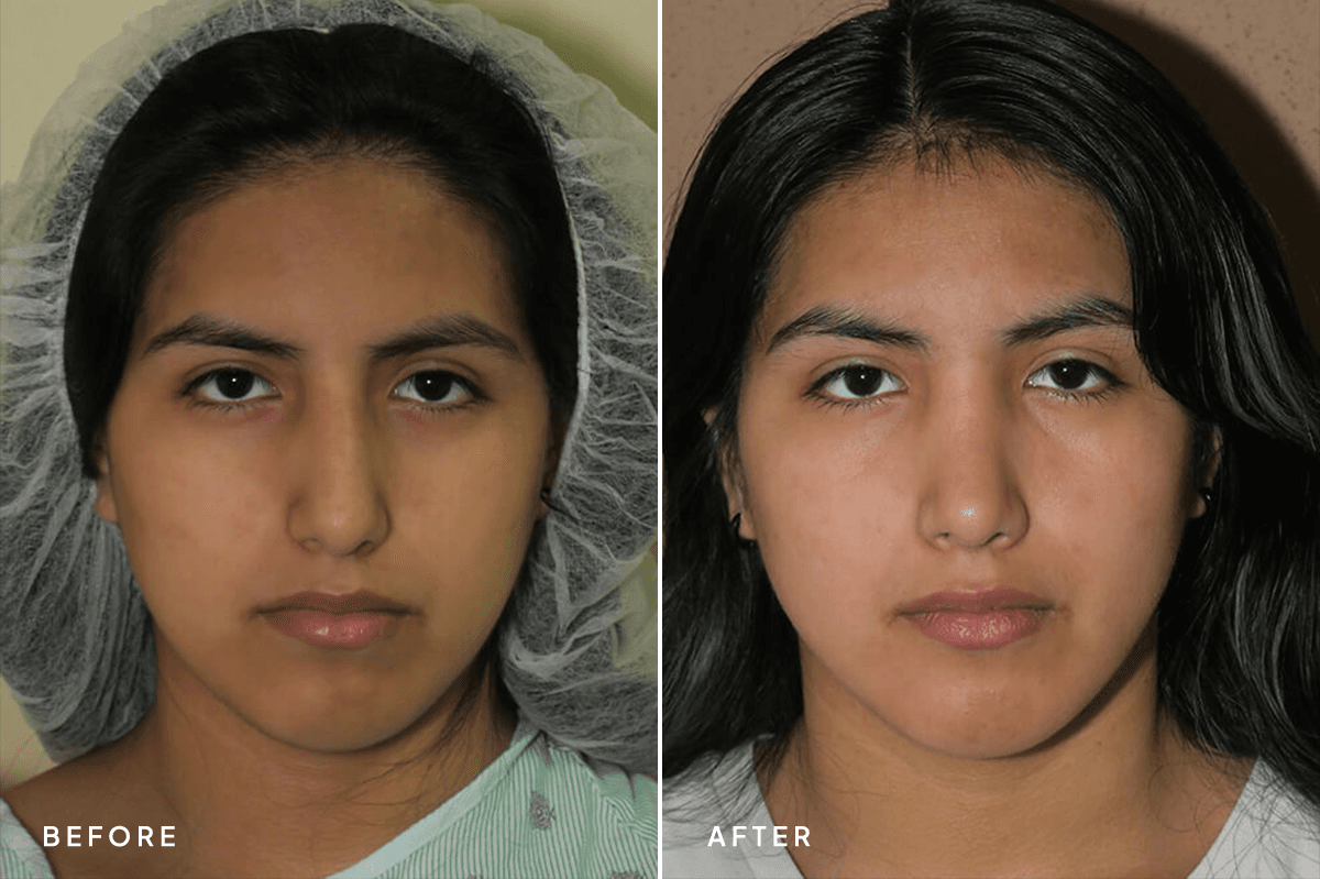New Horizons Face Gallery | Rhinoplasty | 6976-rhinoplasty | A Front