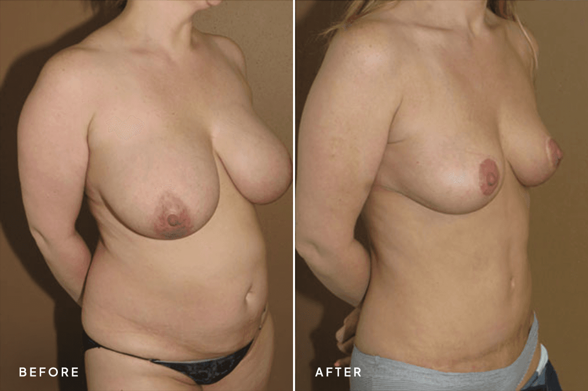 New Horizons Body Gallery | Tummy Tuck | mommy-makeover | C Angle
