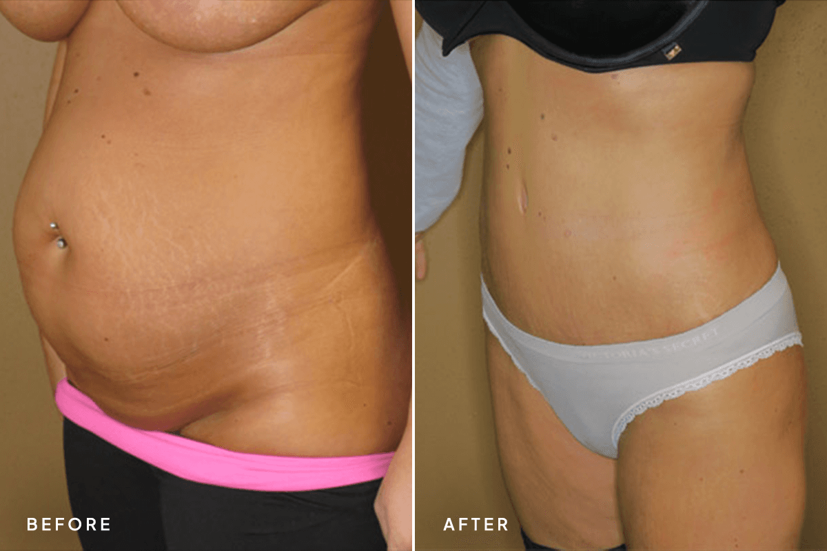 New Horizons Body Gallery | Tummy Tuck | 064-tummy-tuck | C Angle