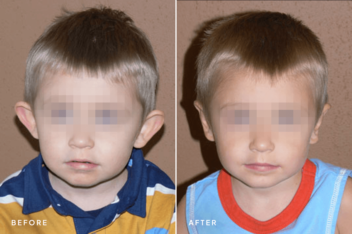 New Horizons Face Gallery | Otoplasty | 01-otoplasty | A Front