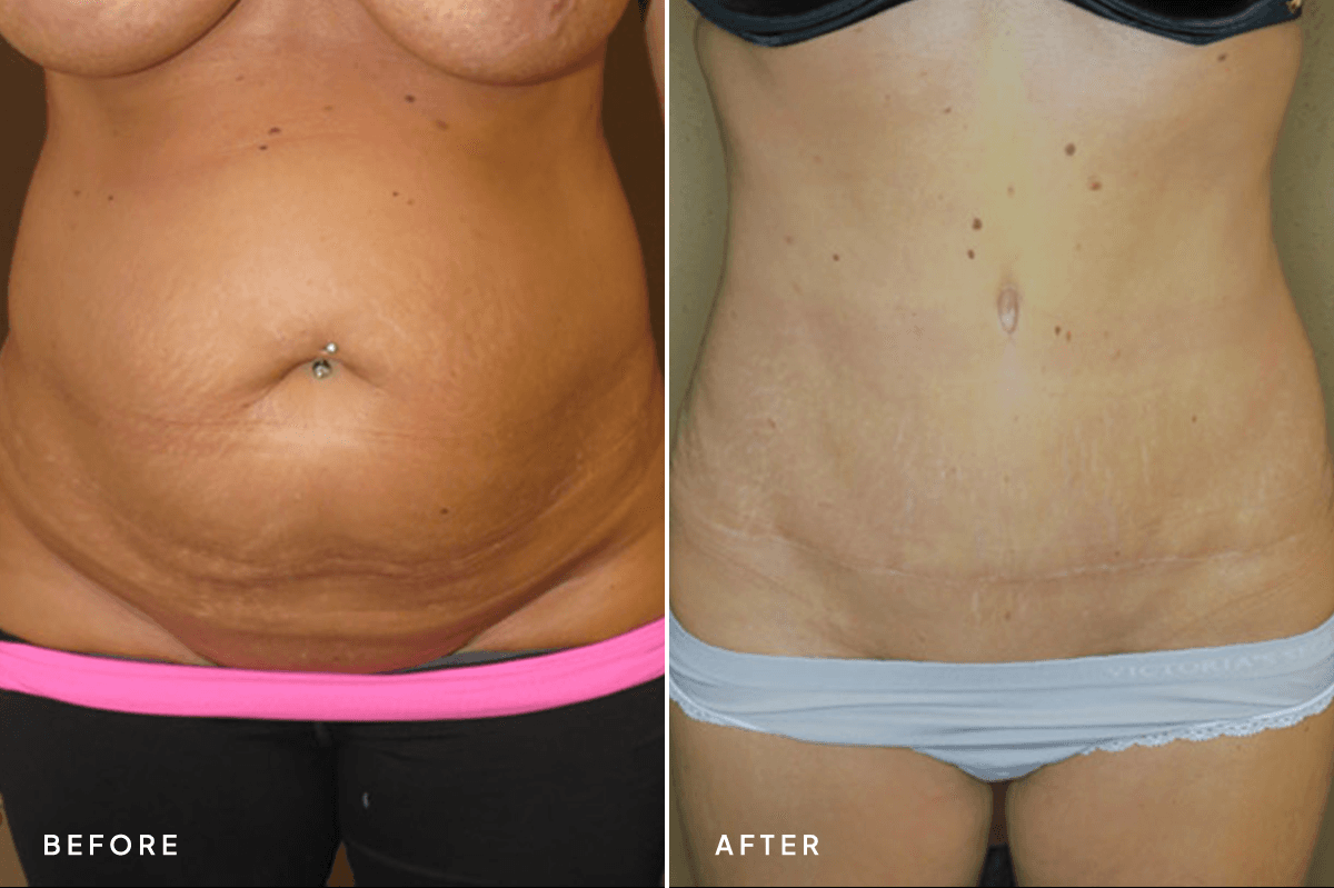 New Horizons Body Gallery | Tummy Tuck | 064-tummy-tuck | A Front