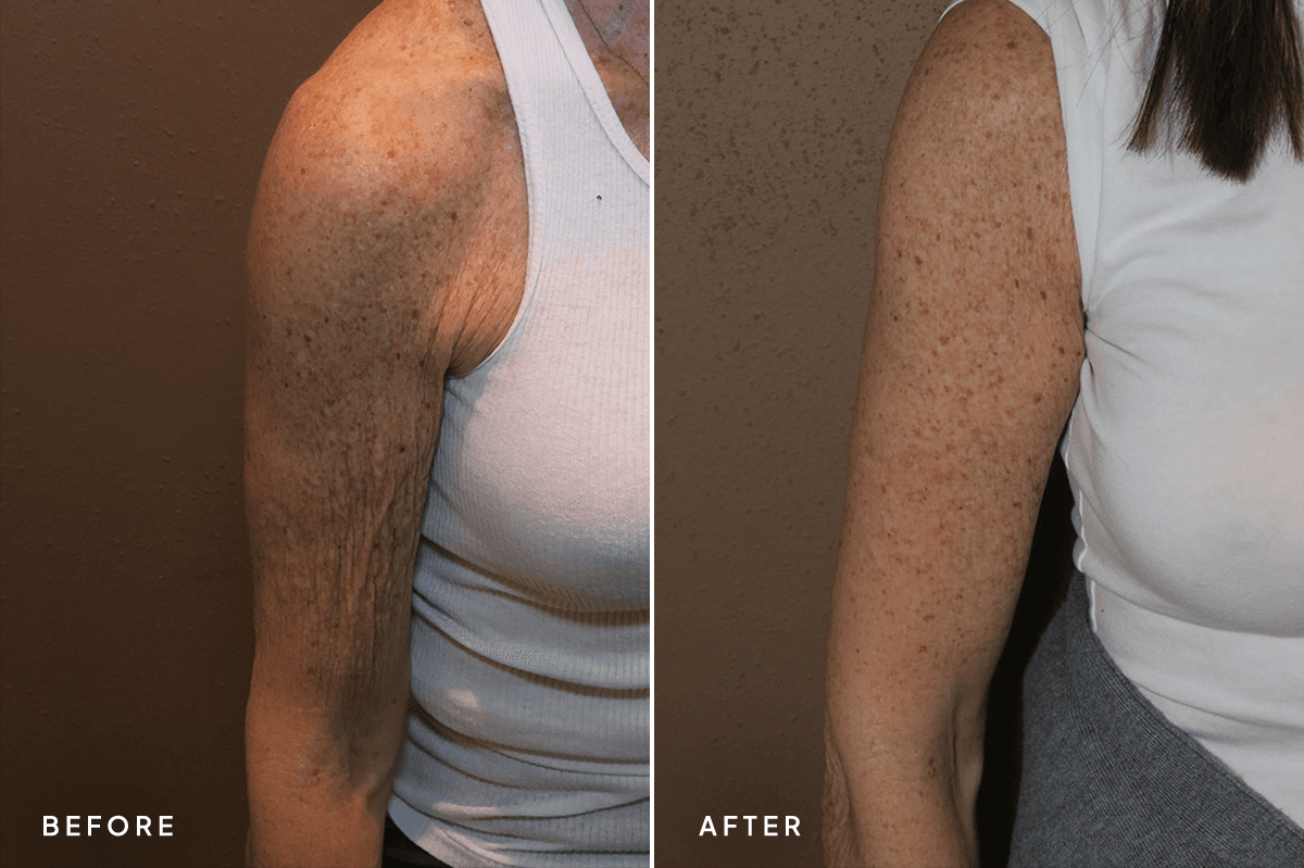 New Horizons Body Gallery | Weight Loss | 28-armlift | A Left