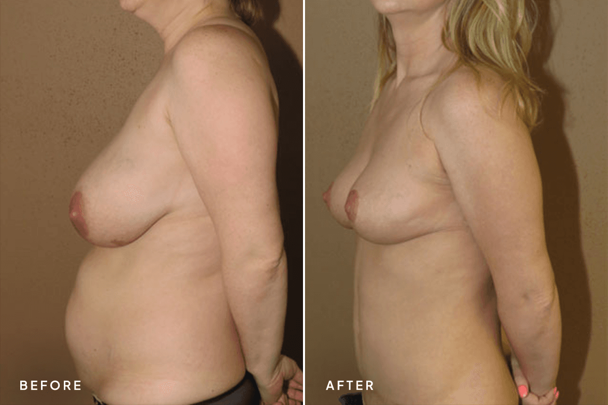New Horizons Body Gallery | Tummy Tuck | mommy-makeover | B Side