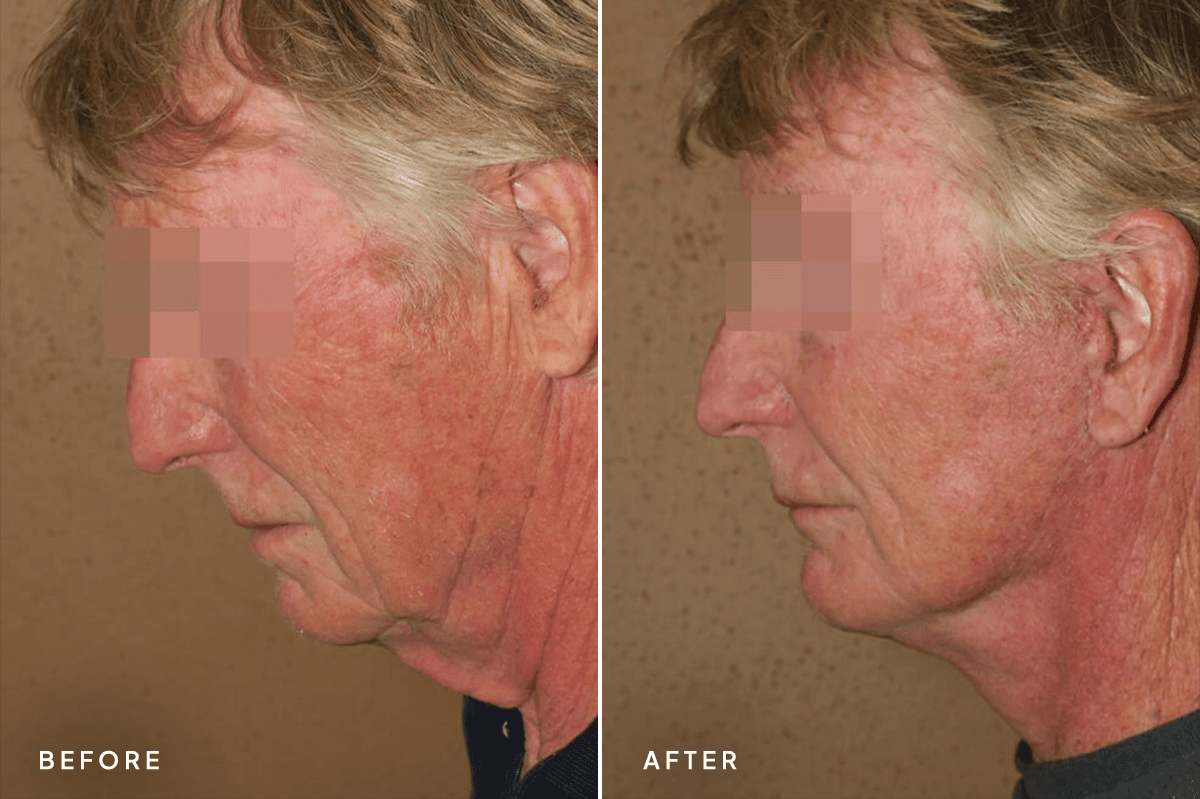 New Horizons Face Gallery | Male Face Neck Lift | 6633-neck-lift | B Side
