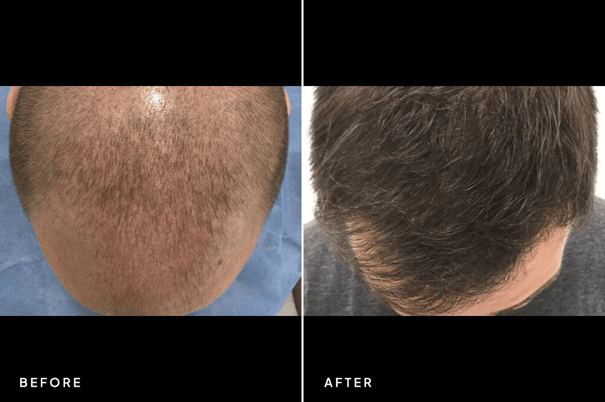 New Horizons Hair Gallery | Hair Transplant | 6625-artas-hair-restoration | B Top