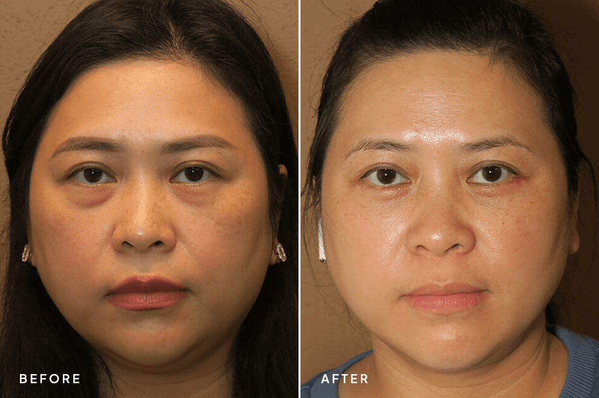 New Horizons Face Gallery | Buccal Fat Pad Removal | 6767-blepharoplasty | A Front