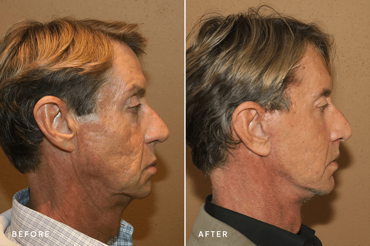 New Horizons Face Gallery | Male Face Neck Lift | 7192-facelift | B Side