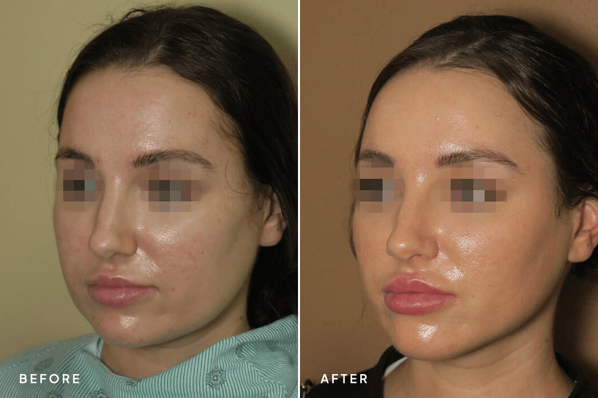 New Horizons Face Gallery | Buccal Fat Pad Removal | 72 liposuction | B Side