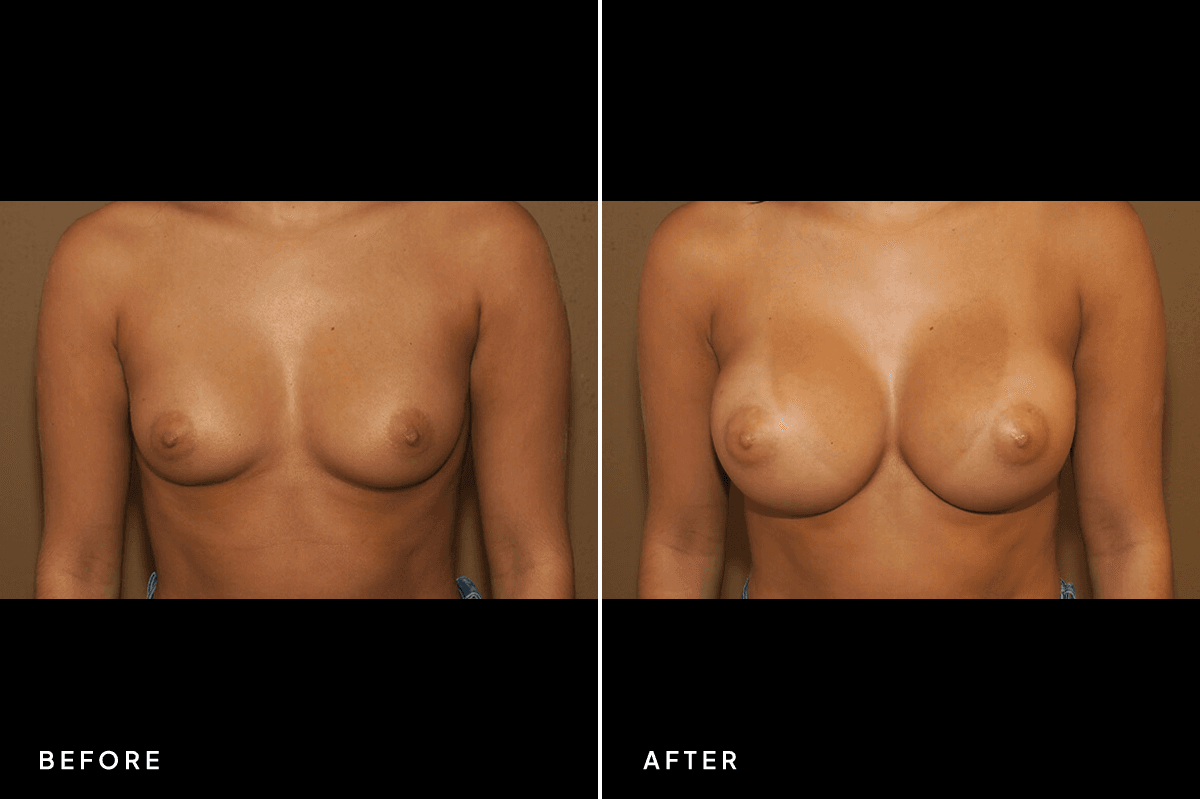 New Horizons Breast Gallery | Breast augmentation - All Endoscopic | 7051-breast-augmentation | A Front