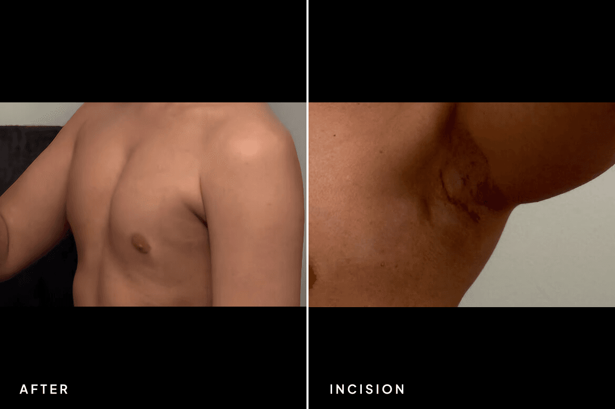 New Horizons Breast Gallery | Pec Implants | 7060-pec-implants | D Incision