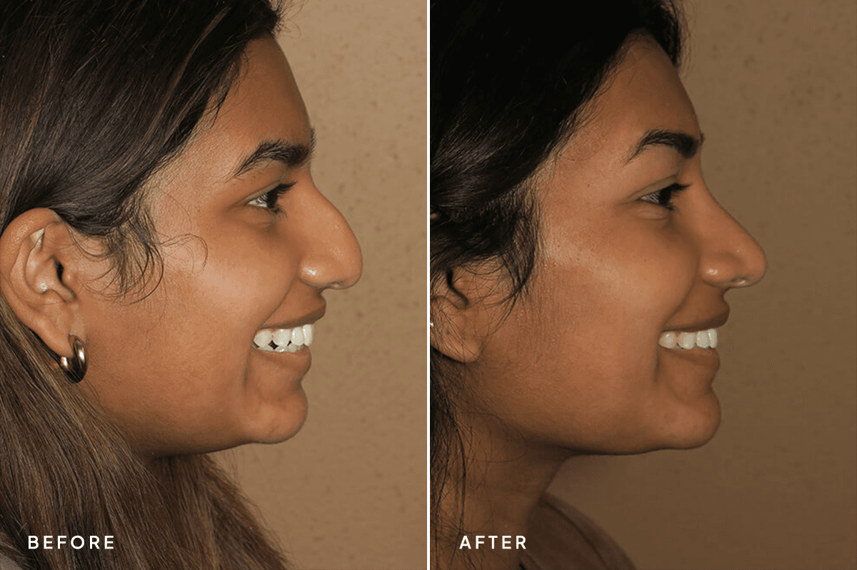New Horizons Face Gallery | Rhinoplasty | 6955-rhinoplasty | B Side