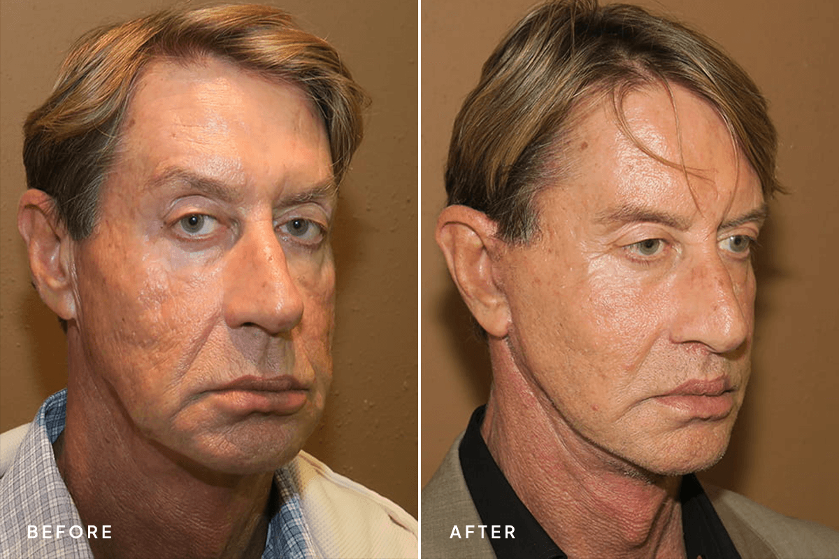 New Horizons Face Gallery | Male Face Neck Lift | 7192-facelift | D Angle