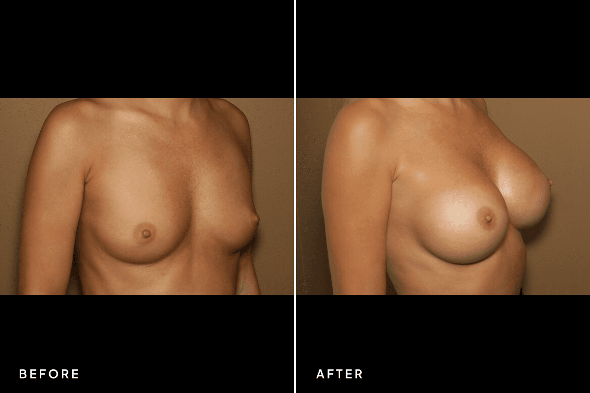 New Horizons Breast Gallery | Breast augmentation - All Endoscopic | 6719-breast-augmentation | B Side