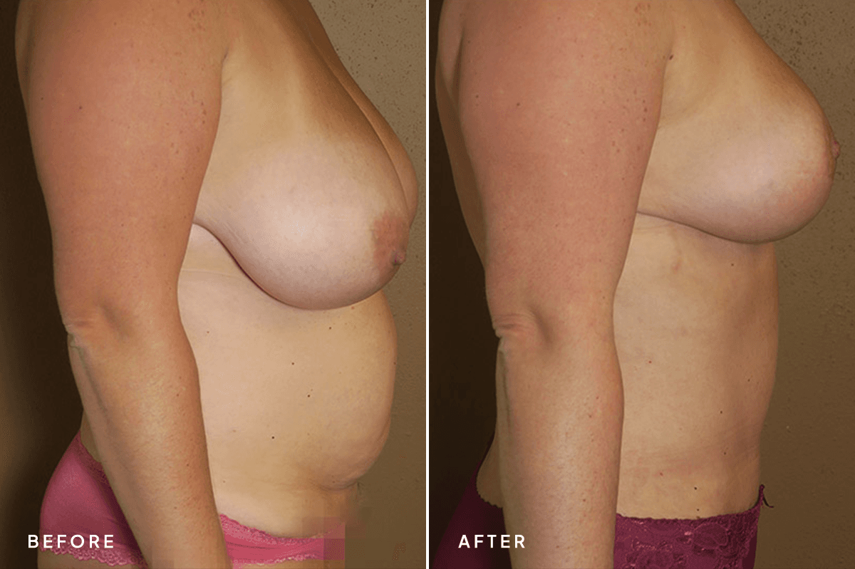 New Horizons Body Gallery | Mommy Makeover | 56-mommy-makeover | B Side