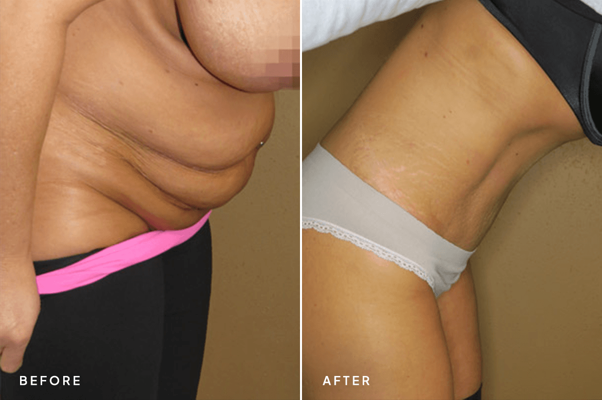 New Horizons Body Gallery | Tummy Tuck | 064-tummy-tuck | D Angle