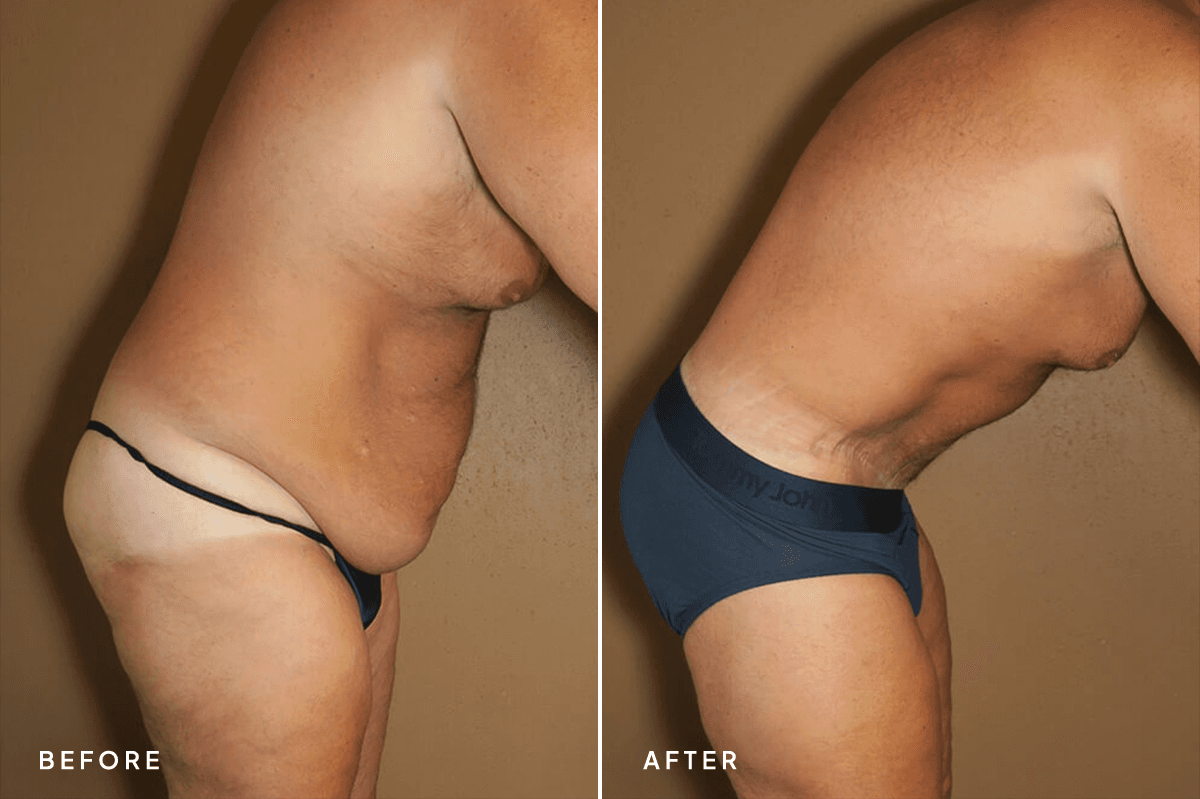 New Horizons Body Gallery | Weight Loss | 6471-body-lift | B Side