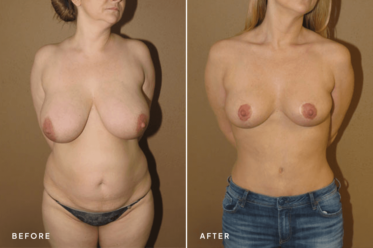 New Horizons Body Gallery | Tummy Tuck | mommy-makeover | A Front