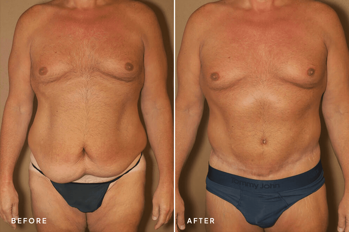 New Horizons Body Gallery | Weight Loss | 6471-body-lift | A Front