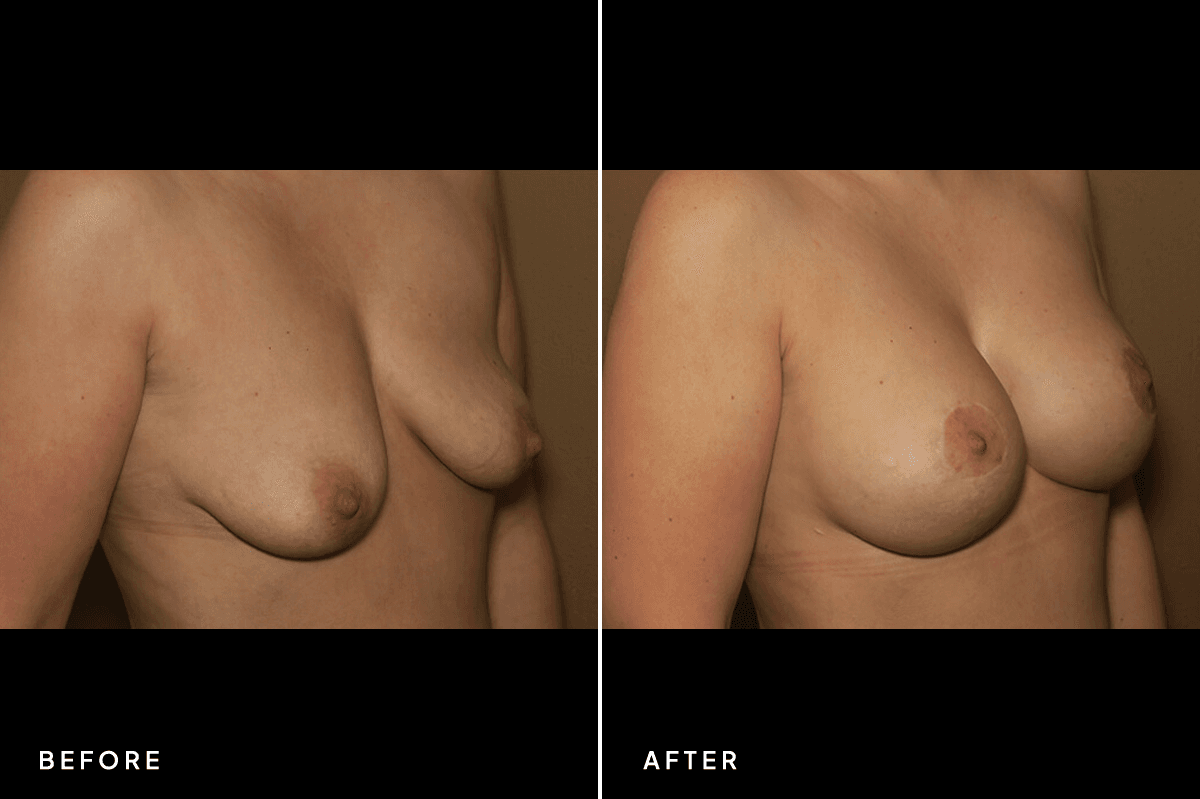 New Horizons Breast Gallery | Breast Lift With Implants | 6952-mastopexy | B Side