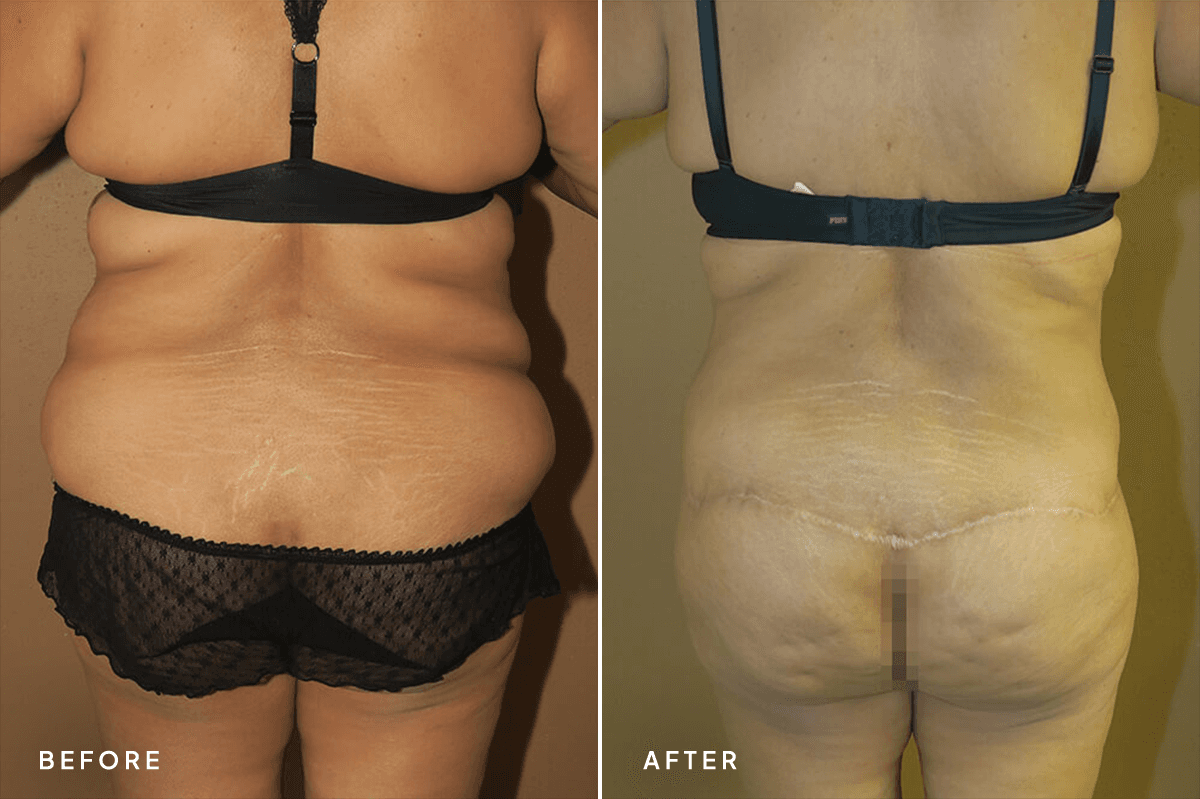 New Horizons Body Gallery | Weight Loss | 7081-belt-lipectomy | B Back