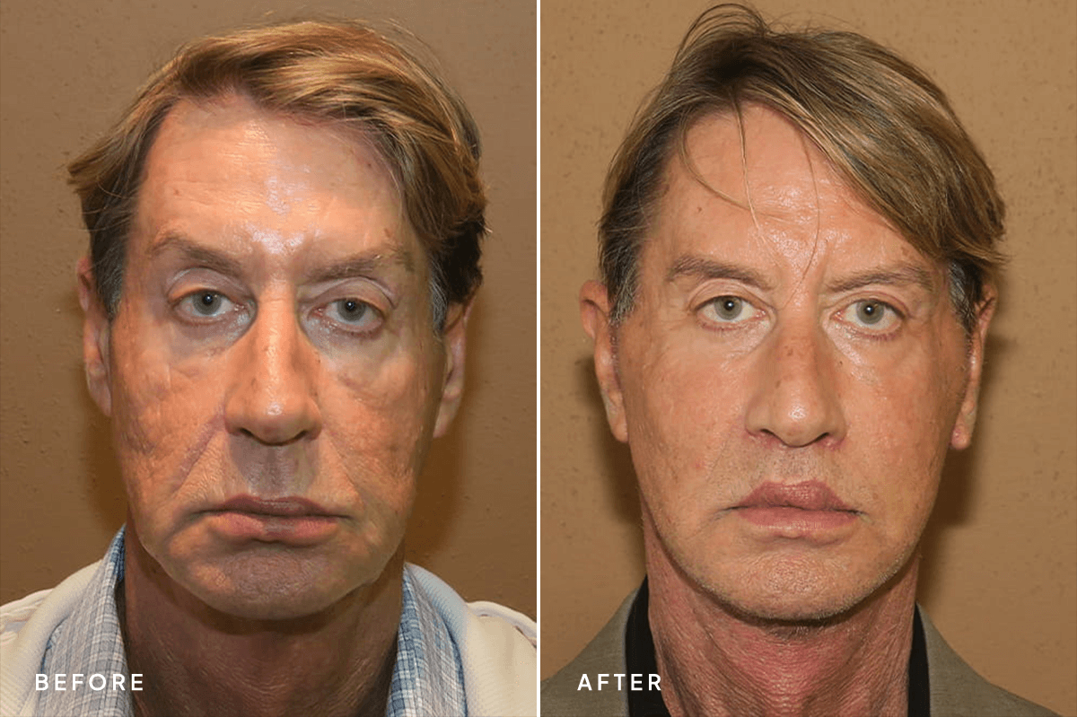 New Horizons Face Gallery | Male Face Neck Lift | 7192-facelift | A Front