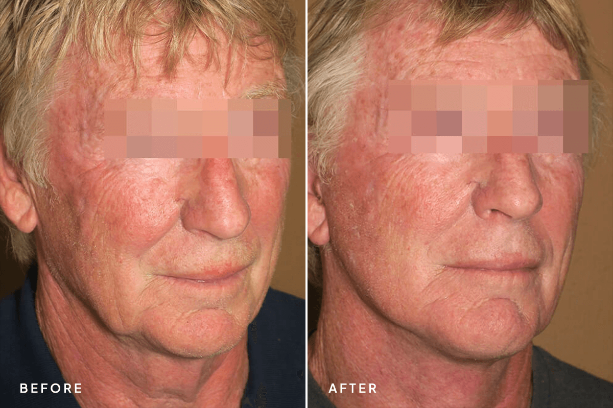 New Horizons Face Gallery | Male Face Neck Lift | 6633-neck-lift | D Angle