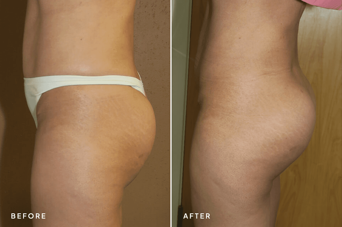 New Horizons Body Gallery | Buttock Augmentation Implants | 7129-buttock-augmentation | B Side